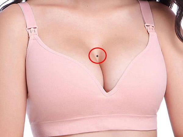 Nốt ruồi trên bầu ngực phụ nữ